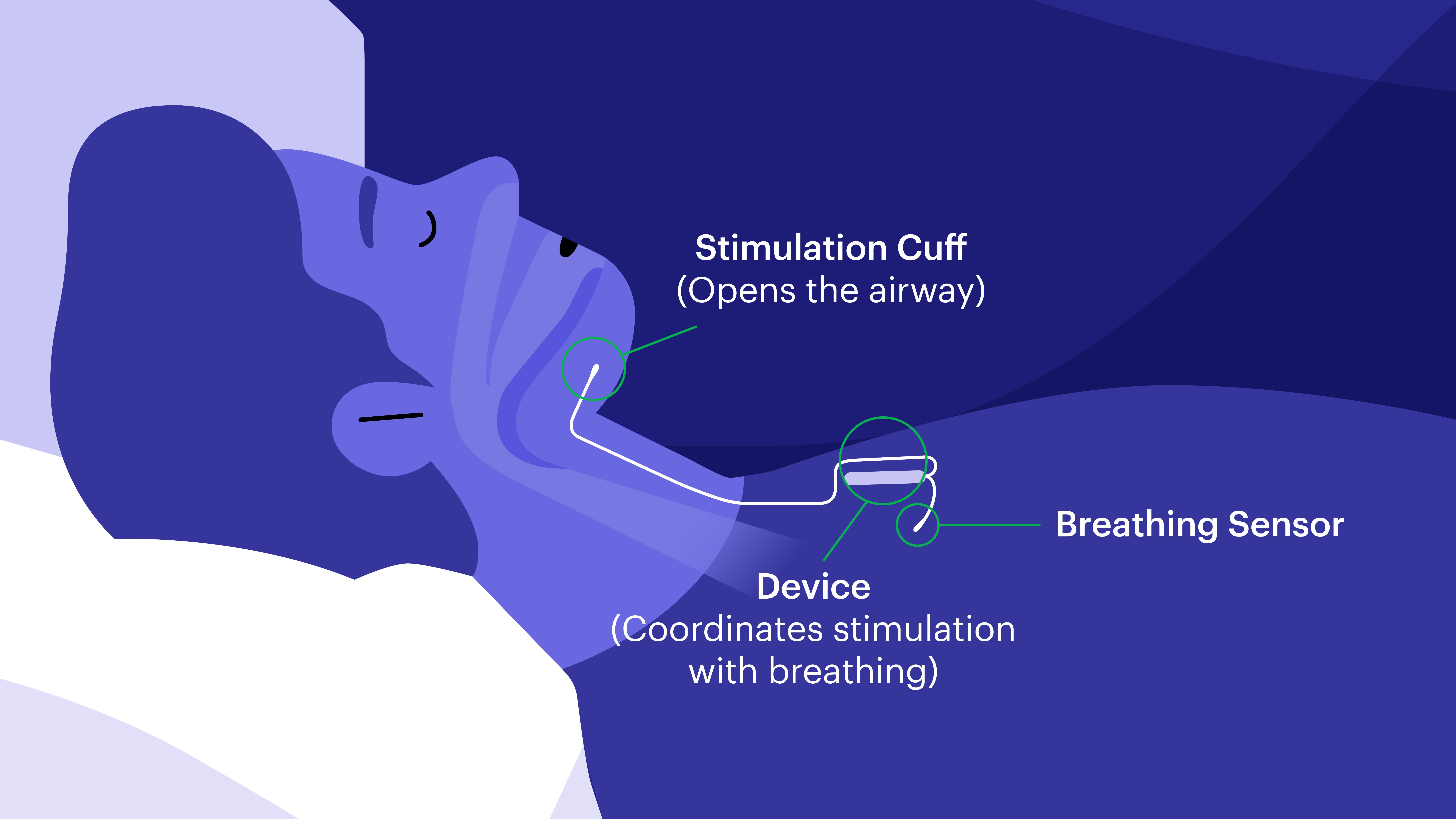 Inspire sleep technology illustration showing stimulation cuff which opens the airway, the device which coordinates stimulation with breathing, and breathing sensor