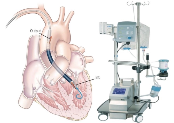Life-saving advanced technologies. Impella 5.0, a temporary pump, is inserted via an artery (left). ECMO emergency life support machine gives a patient's heart and lungs time to rest and heal.